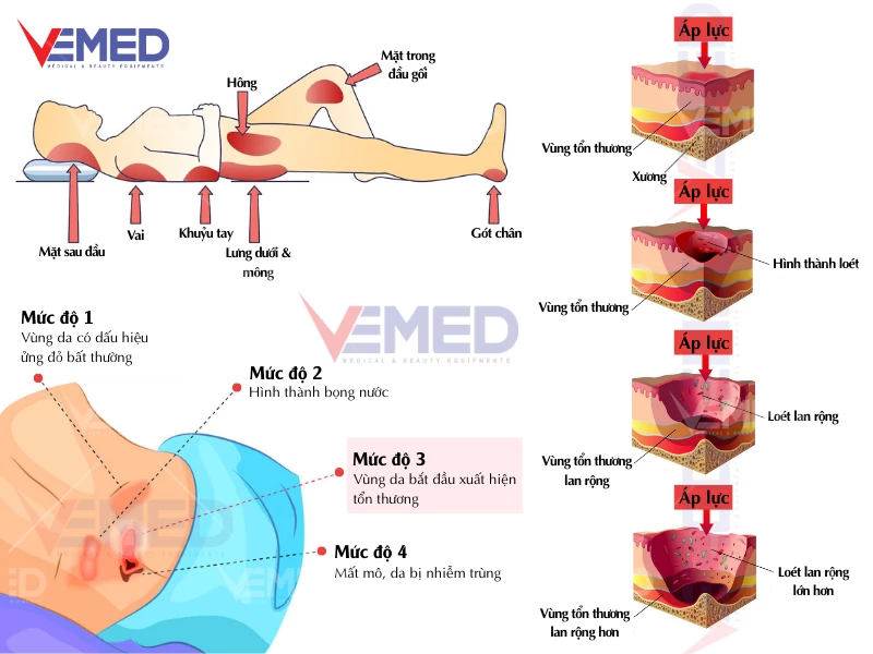 dem-khi-chong-loet-hi-mec-hmam-1010-vemed-1